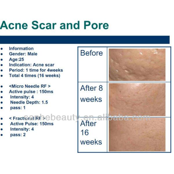 skin lifting machine fractional micro needles RF