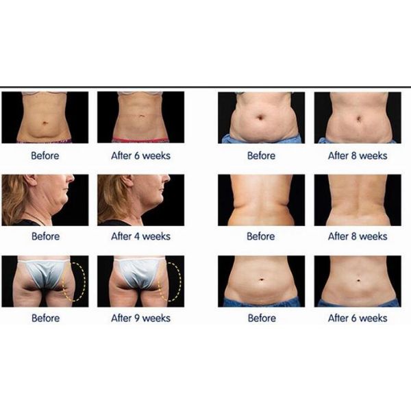 2016 fat freezing body machine/ cryolipolysis slimming machine on sale