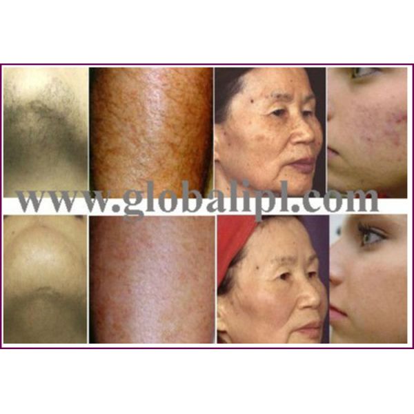2 System In 1 IPL Diode Laser Machine 10.4 inch With 2 Handlepieces Beuaty Equipment