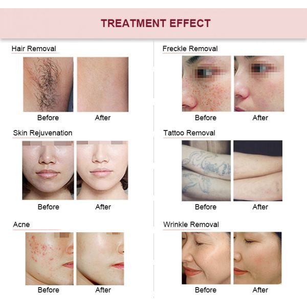 Anti Aging Laser Multifunction Beauty Machine 3 In 1 IP Nd Yag RF Wrinkle Removal Machine