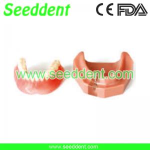 Buy cheap Overdenture inferior with 2 implants product
