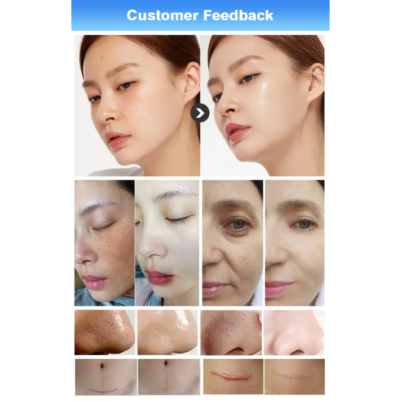 16 In 1 Hydrodermabrasion Facial Machine EMS High Frequency Ultrasonic RF Face Skin Care