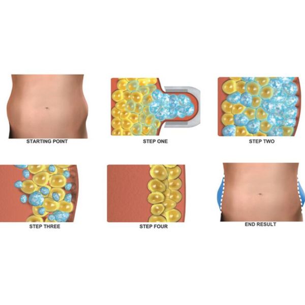 Wholesales Portable Cryolipo Venus Freeze Machine