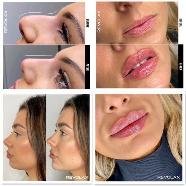 CE Mark Revolax Hyaluronic Acid Dermal Filler Fine Deep Sub Q Revolax