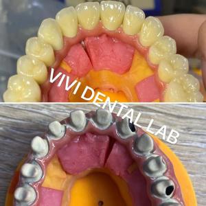 Buy cheap Ivoclar Digital Dental Crowns Process Noritake Porcelain High Accuracy product